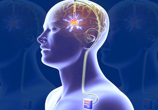 Deep Brain Stimulation: A Futuristic Treatment Model with a Lot of Potential