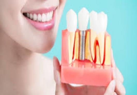 Dental Implants- Promise of Hassle-free, Everlasting Teeth for Psychosocial Wellbeing