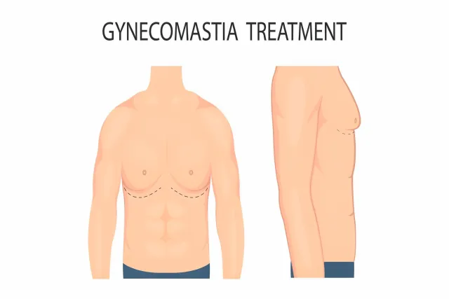Gynecomastia in Men: A Guide to Diagnosis and Treatment Gynecomastia in Men: A Guide to Diagnosis and Treatment