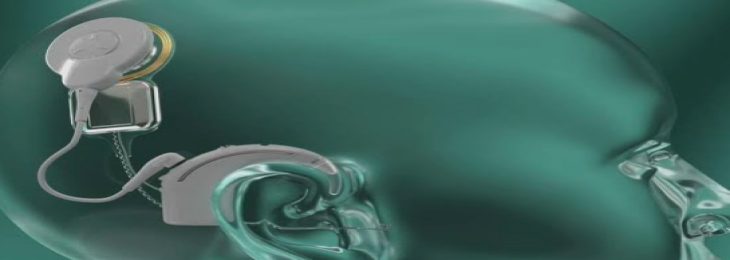 Cochlear has announced that its Nucleus Nexa System, a hearing implant, is now available for US military veterans Cochlear has announced that its Nucleus Nexa System, a hearing implant, is now available for US military veterans